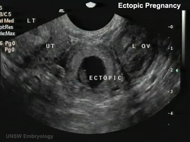 Ectopic 01